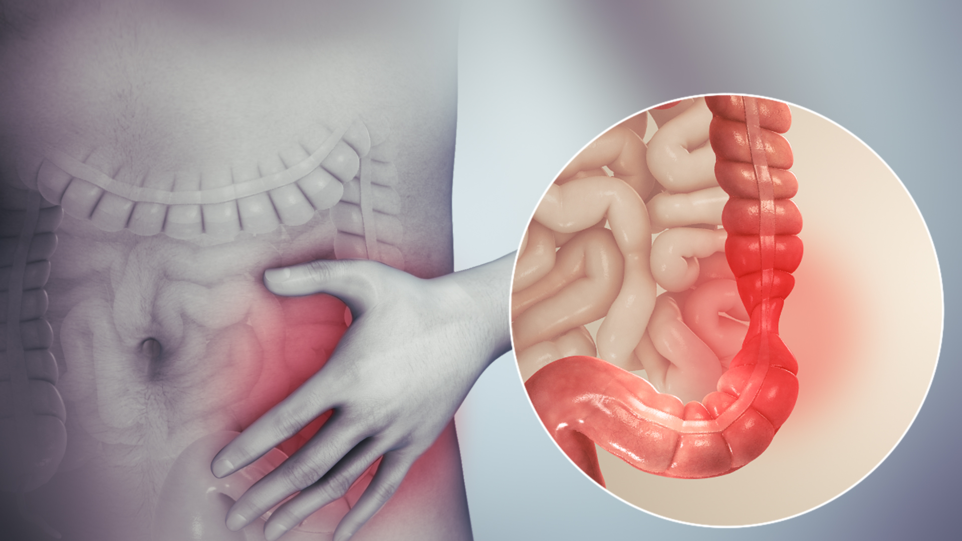 Colitis vs síndrome de intestino irritable: cómo diferenciarlos y cuándo acudir al especialista